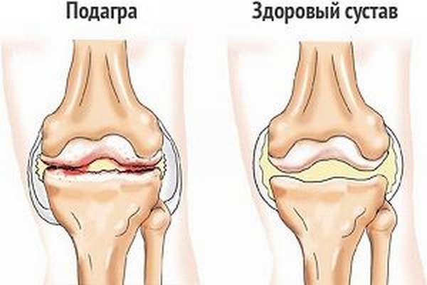 Подагра сустава колена
